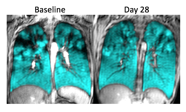 Image of Sam's lungs before and after treatment